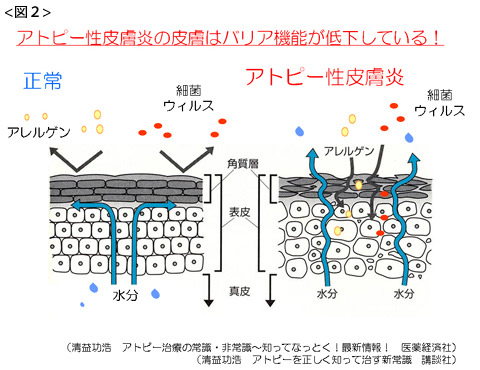 アトピー性皮膚炎 豊中市の小児科 アレルギー科かめさきこども アレルギークリニック