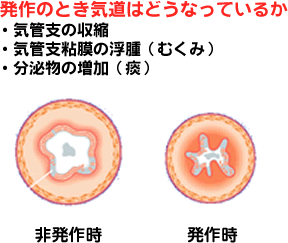 発作のとき気道はどうなっているか。気管支の収縮 、気管支粘膜の浮腫（むくみ）、分泌物の増加(痰)などが起こっています。